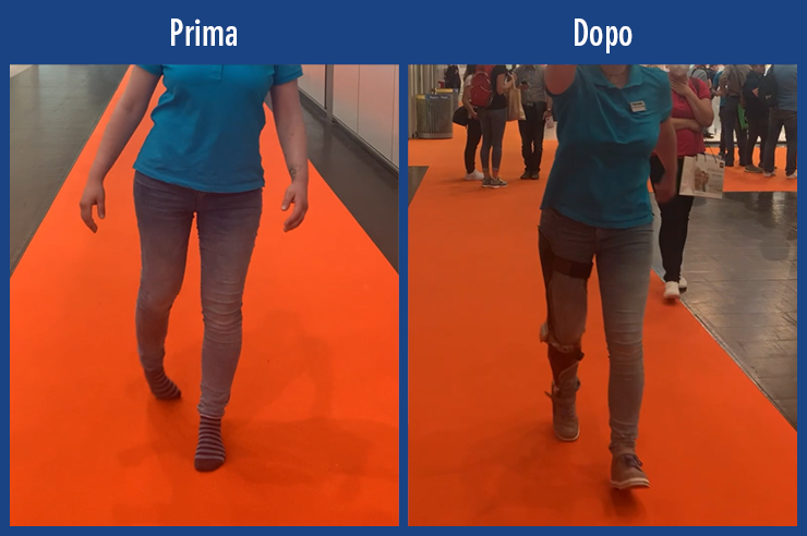 Video di pazienti video di una paziente con monoplegia paralisi di una gamba paralisi alla gamba in seguito ad un incidente sportivo. Confronto della deambulazione prima e dopo senza trattamento e con un’ortesi su tutta la gamba  ortesi KAFO su misura con articolazione per ginocchio modulare NEURO HiTRONIC e articolazione tibiotarsica modulare NEURO SWING 2 per una deambulazione il più possibile fisiologica che consente persino di correre fare jogging.