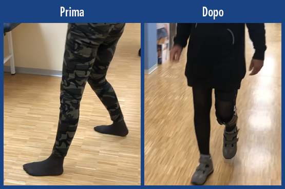 Video di una paziente con paralisi paresi dovuta a una reazione autoimmune associata ad asma cronica. Confronto prima e dopo della deambulazione senza dispositivo ausiliario e con un’ortesi su tutta la gamba KAFO realizzata su misura con articolazione tibiotarsica modulare NEURO SWING e articolazione per ginocchio modulare NEURO TRONIC per il recupero della mobilità.