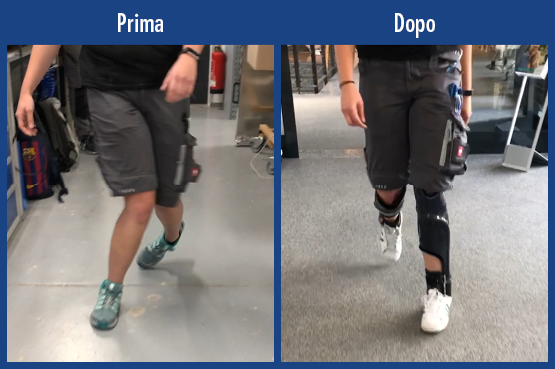 Video di pazienti video di una paziente con paralisi cerebrale CP paraparesi spastica ereditaria malformazione da piede talo-valgo-pronato vizio di postura in valgo. Confronto della deambulazione prima e dopo senza trattamento con due ortesi su misura ortesi ortesi su tutta la gamba KAFO con articolazione per ginocchio modulare NEURO VARIO-SWING e ortesi su tutta la gamba AFO con articolazione tibiotarsica modulare NEURO SWING. Con dispositivi ausiliari raggiunge una sicurezza in deambulazione ed è in grado su terreni in pendenza.