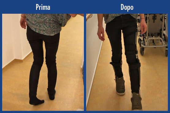 Video di pazienti video di una paziente con sclerosi multipla SM. Confronto della deambulazione prima e dopo senza trattamento con due ortesi su misura ortesi ortesi su tutta la gamba KAFO con articolazione per ginocchio modulare NEURO VARIO e ortesi su tutta la gamba AFO con articolazione tibiotarsica modulare NEURO SWING. Con dispositivi ausiliari raggiunge una sicurezza in deambulazione e rimane nella vita quotidiana flessibile e mobile.